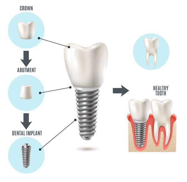 Got A Missing Tooth? Dental Implants